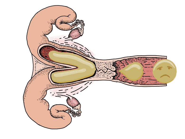 Gebärmuttererkrankungen Gebärmuttererkrankungen bei Kühen von Metritis bis Pyometra: Symptome, Ursachen, Diagnostik und Folgen für Zyklus und Fruchtbarkeit.